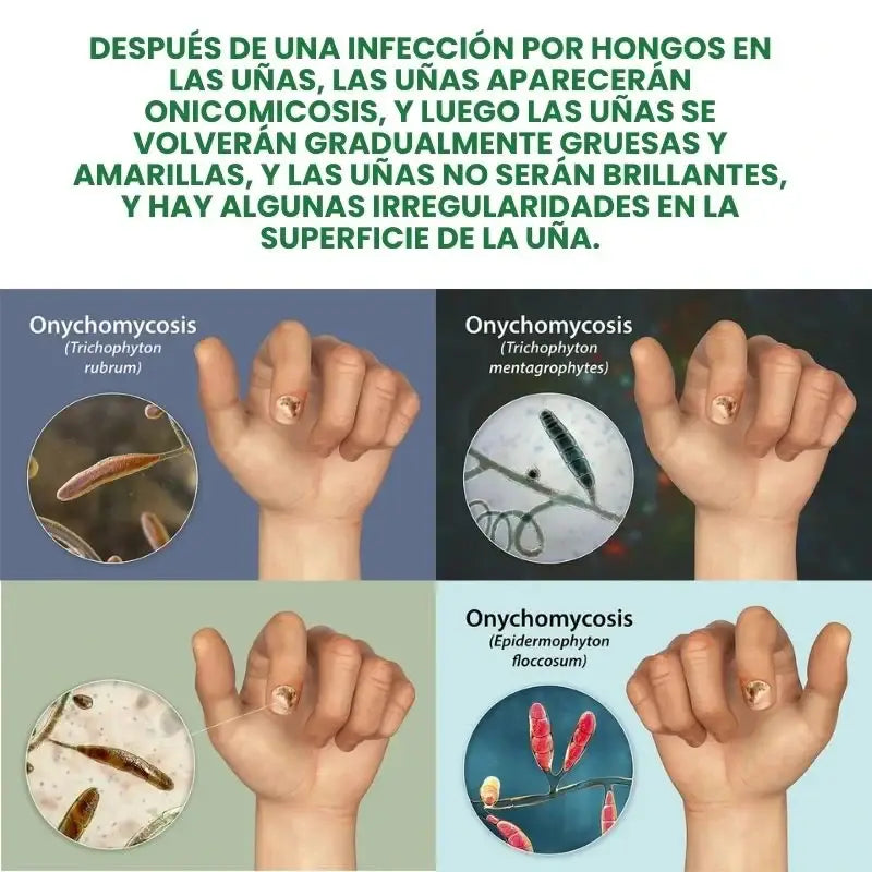 7 Days Fungus Free Nails® - Elimina El Hongo de Tus Uñas ➕ Envió Gratis