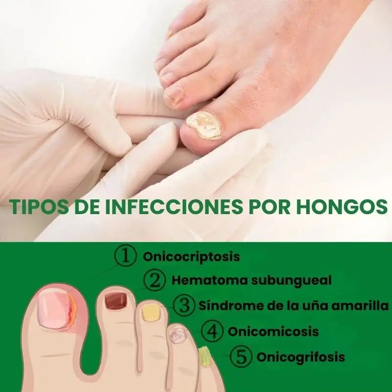 7 Days Fungus Free Nails® - Elimina El Hongo de Tus Uñas ➕ Envió Gratis