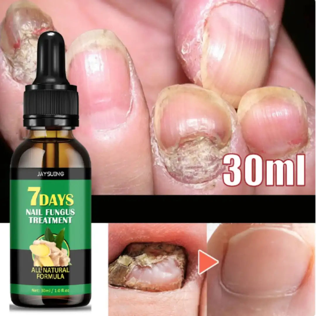 7 Days Fungus Free Nails® - Elimina El Hongo de Tus Uñas ➕ Envió Gratis