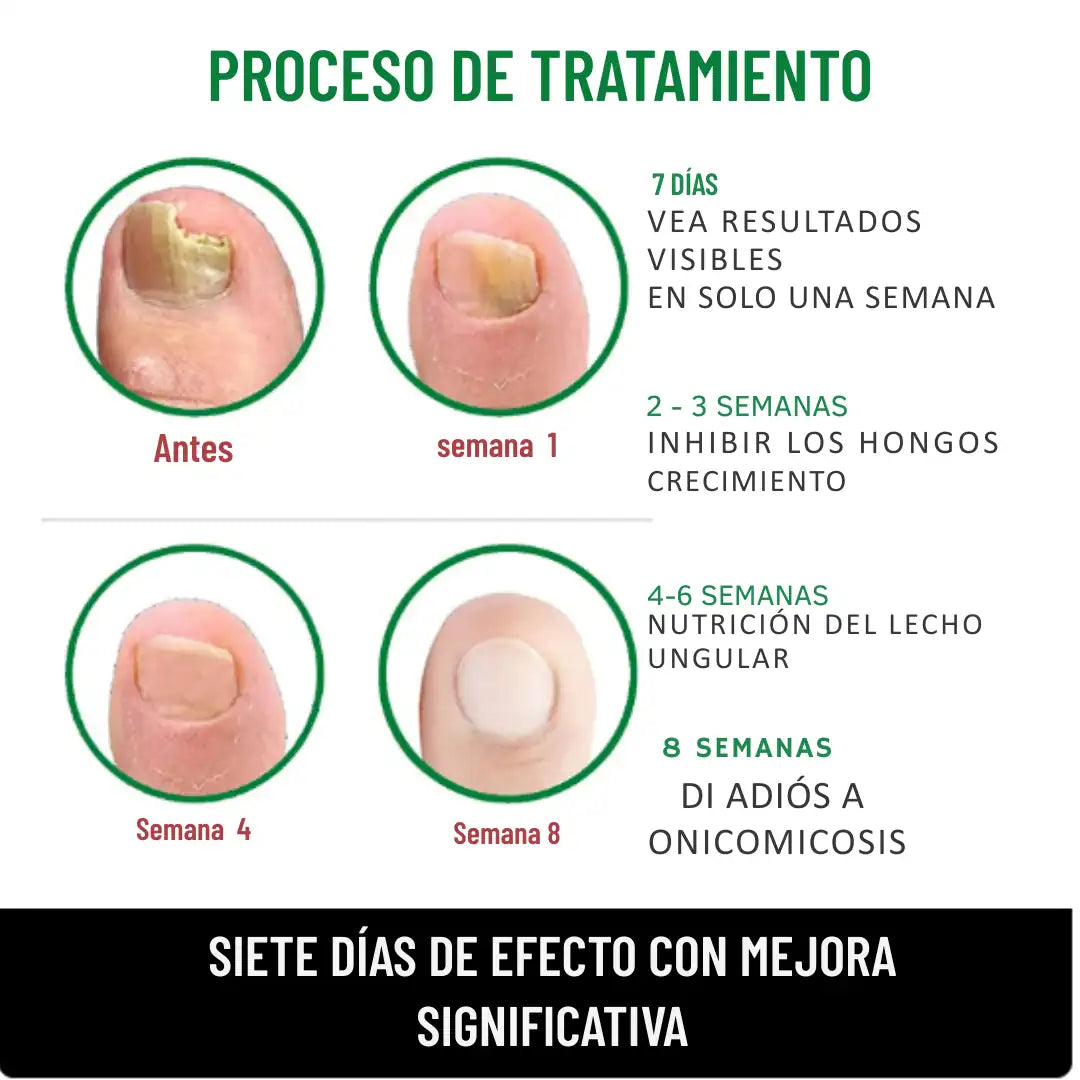 7 Days Fungus Free Nails® - Elimina El Hongo de Tus Uñas ➕ Envió Gratis