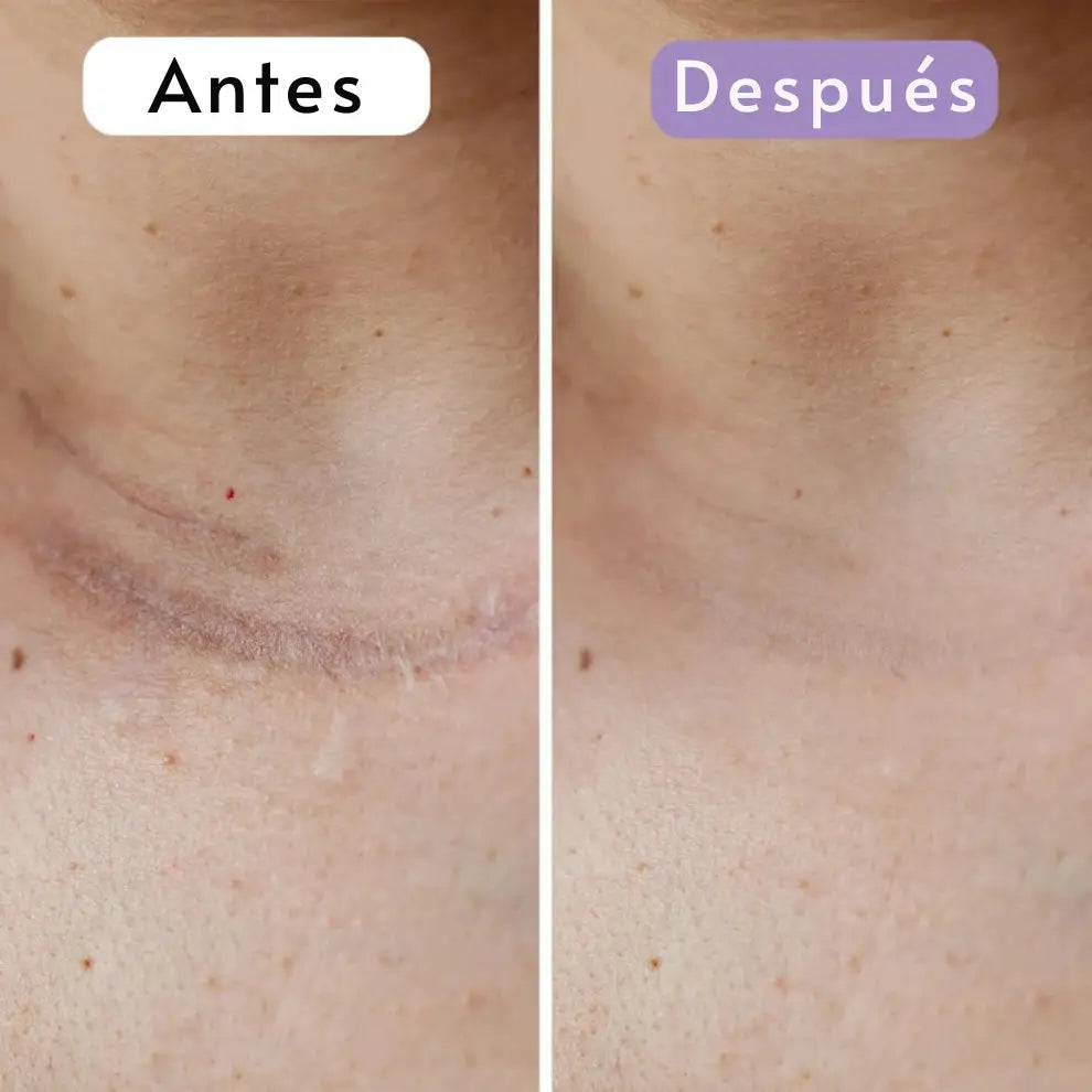 Cinta Cicatrizante de Silicona Contra Cicatrices y Arrugas ➕ Envío Gratis