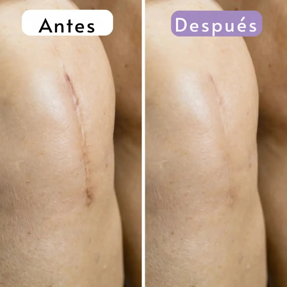 Cinta Cicatrizante de Silicona Contra Cicatrices y Arrugas ➕ Envío Gratis