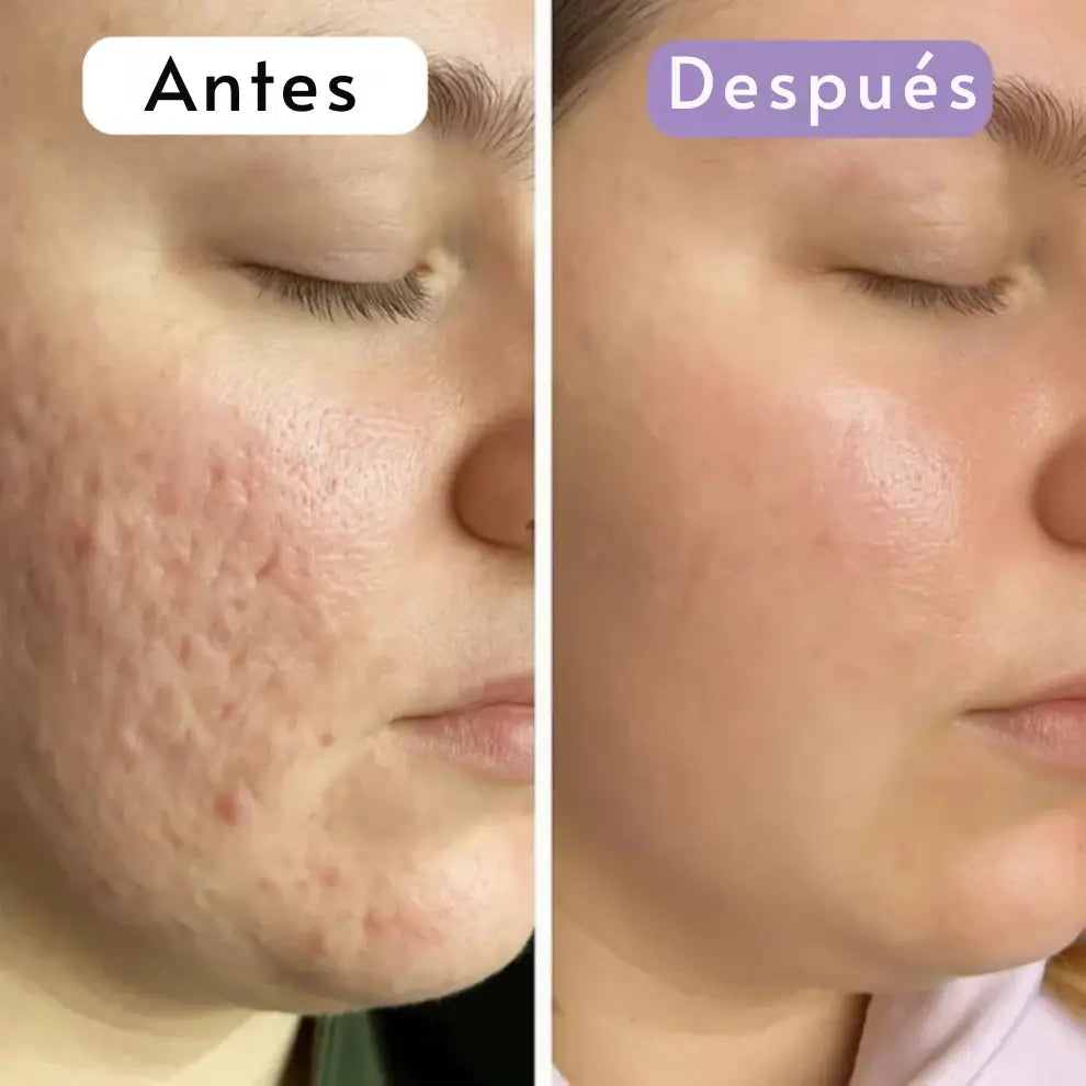 Cinta Cicatrizante de Silicona Contra Cicatrices y Arrugas ➕ Envío Gratis
