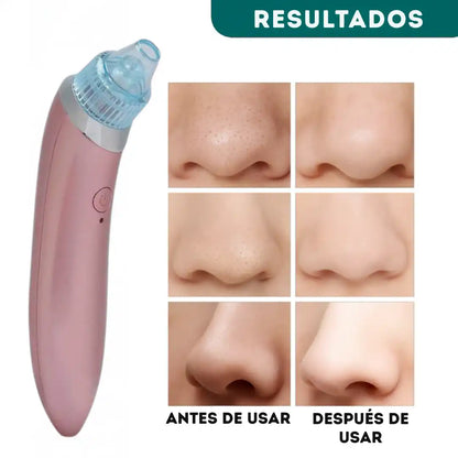 Purificar los Poros con Extractor De Puntos Negros Y Espinillas ➕ Envío Gratis