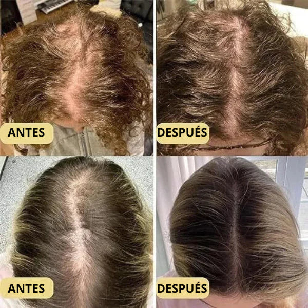 Aceite Natural Veganic 🎁 Compra 1 Lleva 2 - Para Doble Crecimiento del Cabello ➕ Envío Gratis